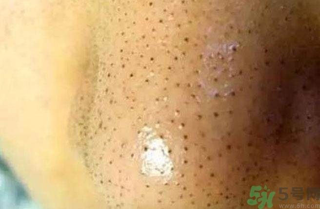 什么樣的痘痘能擠？哪些痘痘不能擠？