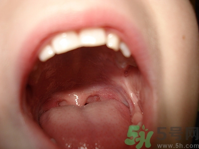 花椒能治牙痛嗎?花椒為什么治牙痛 花椒能治牙痛嗎?花椒為什么治牙痛