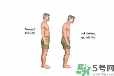 僵直性脊椎炎的癥狀有哪些？怎樣預(yù)防僵直性脊椎炎？