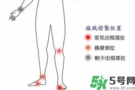 引發(fā)痛風(fēng)的原因是什么？痛風(fēng)病人飲食需注意什么好？