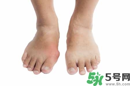 引發(fā)痛風(fēng)的原因是什么？痛風(fēng)病人飲食需注意什么好？