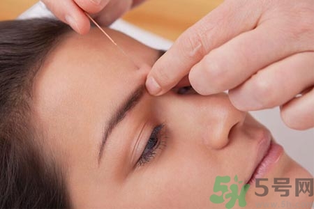 針灸一次要扎多長時間？針灸可以幾天做一次？
