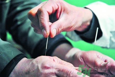 針灸一次要扎多長時間？針灸可以幾天做一次？