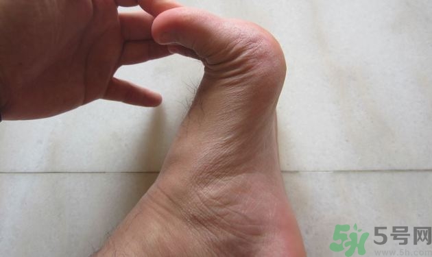 腳拇指外翻遺傳嗎？腳拇指外翻怎么矯正？