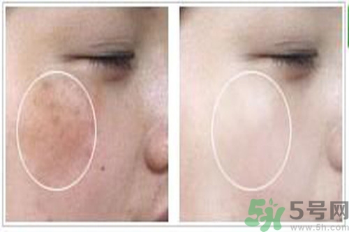 曬斑可以自己消退嗎？曬斑可以用激光去除嗎？