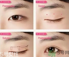 雙眼皮埋線可以重做嗎?雙眼皮埋線可以拆嗎? 雙眼皮埋線可以重做嗎?雙眼皮埋線可以拆嗎?