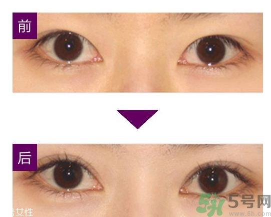 雙眼皮埋線可以重做嗎?雙眼皮埋線可以拆嗎? 雙眼皮埋線可以重做嗎?雙眼皮埋線可以拆嗎?