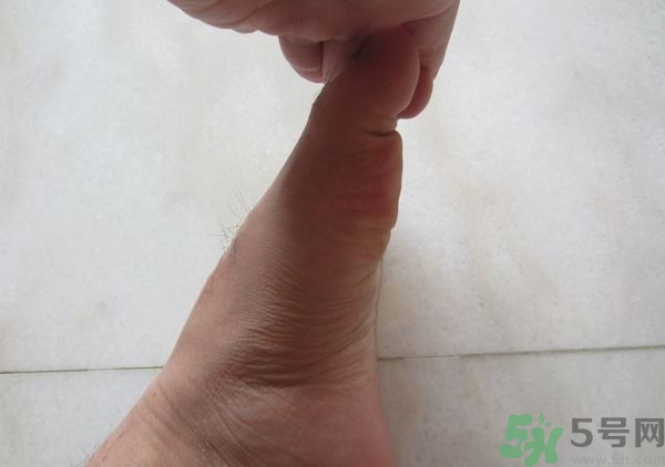 腳拇指外翻遺傳嗎？腳拇指外翻怎么矯正？