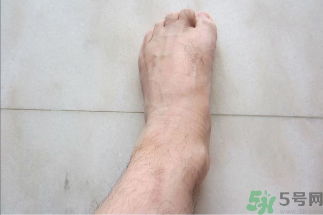 腳拇指外翻遺傳嗎？腳拇指外翻怎么矯正？