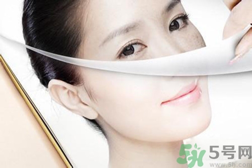 曬斑可以自己消退嗎？曬斑可以用激光去除嗎？