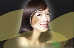 曬斑可以自己消退嗎？曬斑可以用激光去除嗎？