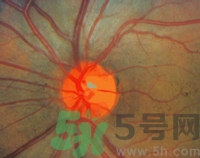 青光眼可以治愈嗎？青光眼怎樣治療？