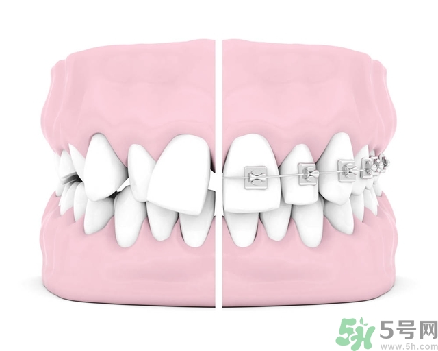 牙齒橫著長怎么辦？智齒橫著長一定要拔嗎？