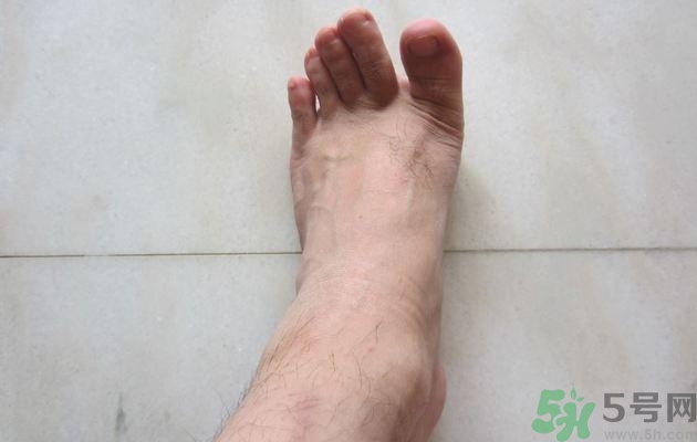 腳拇指外翻遺傳嗎？腳拇指外翻怎么矯正？