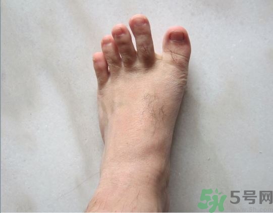 腳拇指外翻遺傳嗎？腳拇指外翻怎么矯正？