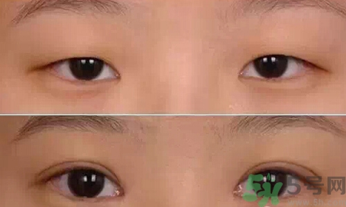 天生腫眼泡怎么消除？天生腫眼泡怎么辦？