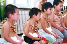 小孩可以拔罐嗎？寶寶能拔火罐嗎？