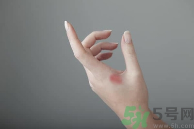 手被燙紅了怎么辦？手被燙了怎么止痛？