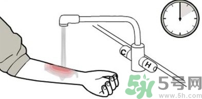 手被燙紅了怎么辦？手被燙了怎么止痛？