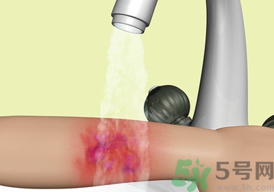 手被燙紅了怎么辦？手被燙了怎么止痛？