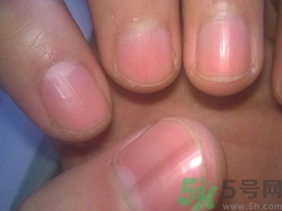 指甲上有豎紋是怎么回事?指甲上有豎紋吃什么好 指甲上有豎紋是怎么回事?指甲上有豎紋吃什么好