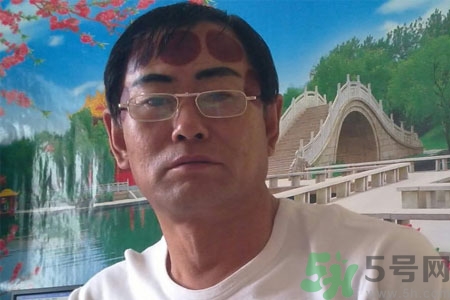 頭痛可以在額頭上拔火罐嗎？額頭上拔火罐有什么好處？