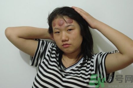 頭痛可以在額頭上拔火罐嗎？額頭上拔火罐有什么好處？