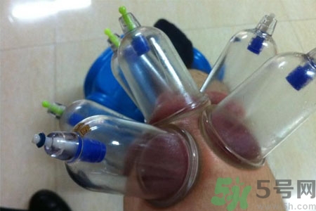 膝蓋能拔罐嗎？膝蓋疼可以拔罐嗎？