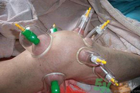 膝蓋能拔罐嗎？膝蓋疼可以拔罐嗎？