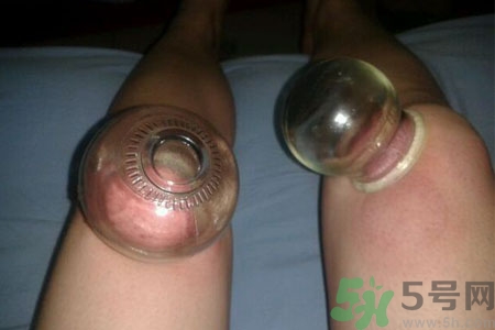 膝蓋能拔罐嗎？膝蓋疼可以拔罐嗎？