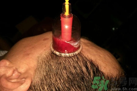 太陽穴可以拔火罐嗎？偏頭疼可以在太陽穴拔火罐嗎？