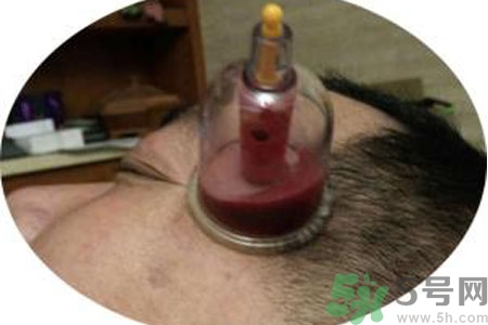 太陽穴可以拔火罐嗎？偏頭疼可以在太陽穴拔火罐嗎？