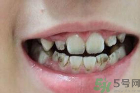 小孩牙齒發(fā)黑怎么回事？小孩牙齒發(fā)黑怎么辦？