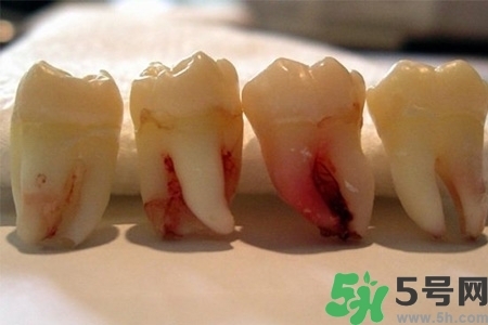 智齒長歪了一定要拔嗎？智齒長歪了必須拔嗎？