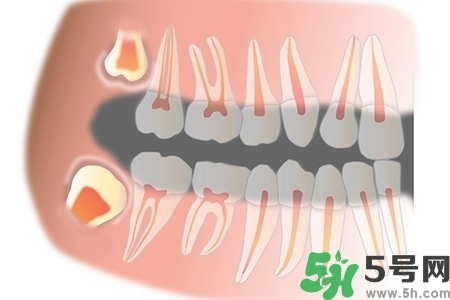 智齒長歪了一定要拔嗎？智齒長歪了必須拔嗎？