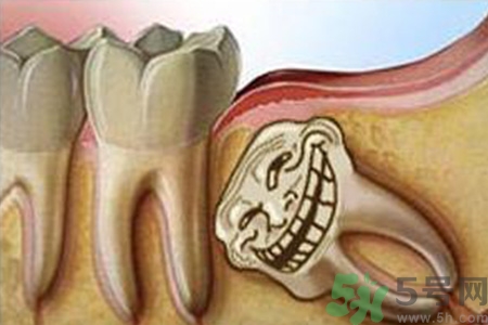 智齒長歪了一定要拔嗎？智齒長歪了必須拔嗎？