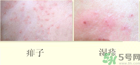 濕疹和痱子一樣嗎？濕疹和痱子有甚么區(qū)別？