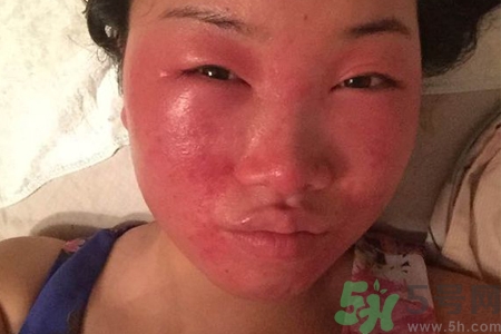 臉過(guò)敏發(fā)紅癢怎么辦？臉過(guò)敏發(fā)紅癢擦什么藥好？