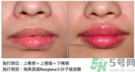 玻尿酸豐唇能保持多久?玻尿酸豐唇后注意什么? 玻尿酸豐唇能保持多久?玻尿酸豐唇后注意什么?