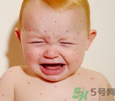 新生兒濕疹怎么引起的？新生兒濕疹如何處理？