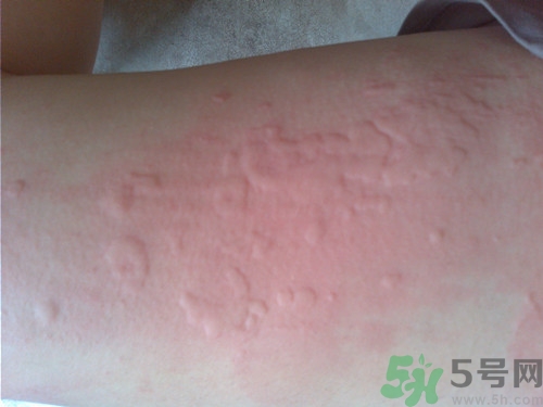 蕁麻疹能否根治?蕁麻疹該怎么治療 蕁麻疹能否根治?蕁麻疹該怎么治療