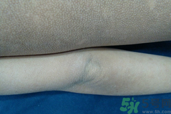 雞皮膚可以根治嗎?雞皮膚怎么消除最有效 雞皮膚可以根治嗎?雞皮膚怎么消除最有效