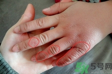 生凍瘡癢怎么辦？生凍瘡很癢的時(shí)候怎么辦？