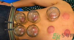 拔罐后罐印顏色越深代表什么? 拔罐后罐印顏色越深代表什么?