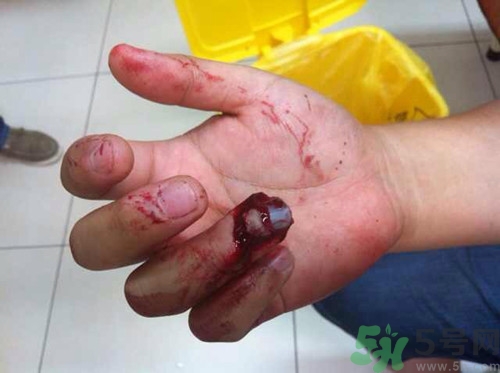 手被門(mén)夾了有淤血怎么辦?手被門(mén)夾了怎么緩解疼痛 手被門(mén)夾了有淤血怎么辦?手被門(mén)夾了怎么緩解疼痛