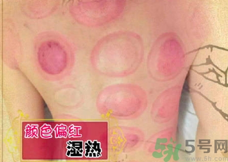 拔罐后罐印顏色越深代表什么? 拔罐后罐印顏色越深代表什么?