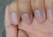 ?指甲上有豎紋是缺什么？指甲上有豎紋是缺維生素嗎？