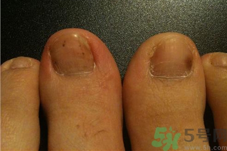 腳趾甲變黑是什么原因？腳趾甲變黑是怎么回事？