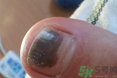 腳趾甲變黑是什么原因？腳趾甲變黑是怎么回事？
