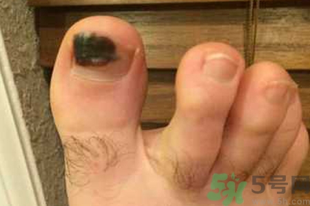 腳趾甲變黑是什么原因？腳趾甲變黑是怎么回事？